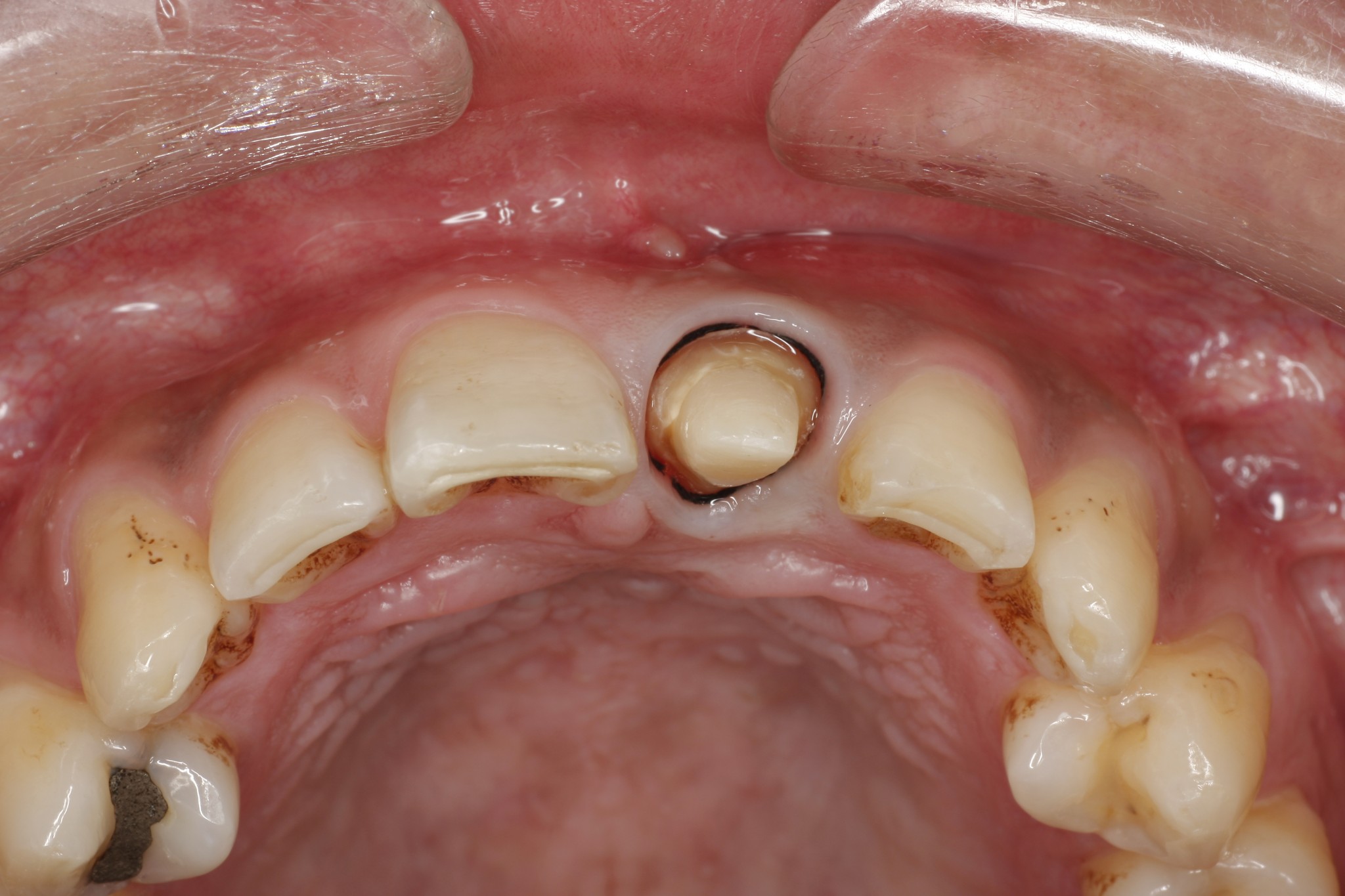 美しい型取りのために 御茶ノ水 小川町の歯医者 塚原デンタルクリニック
